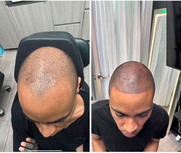 Cosmetic Tattoos hair tattoo on Scalp by transcendingink on TattMe